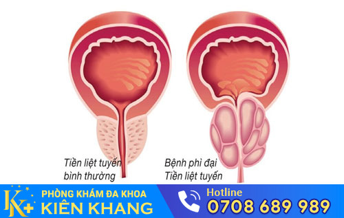 Phì đại tuyến tiền liệt