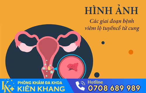 Hình ảnh viêm lộ tuyến cổ tử cung