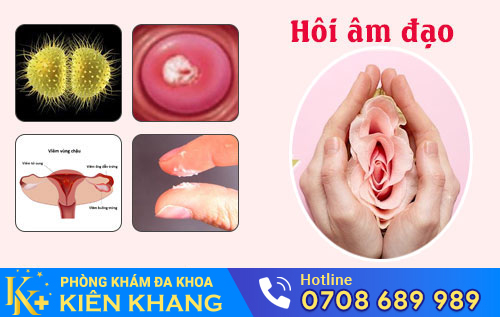 Hôi âm đạo