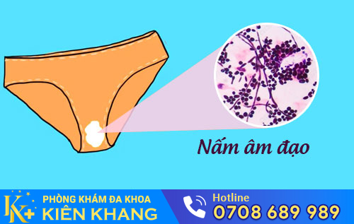 Nấm âm đạo