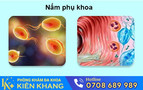 Nấm phụ khoa