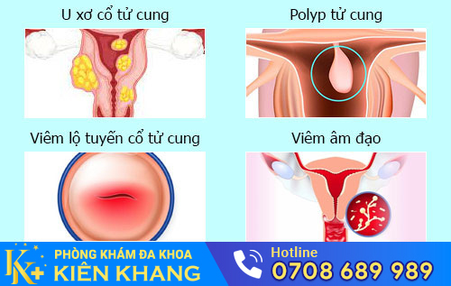 Nguyên nhân khí hư có màu trắng