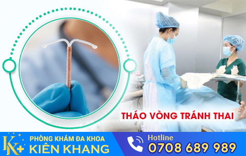 Tháo vòng tránh thai