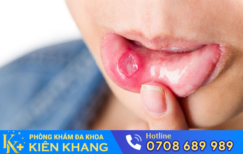 bieu hien benh lau o mieng