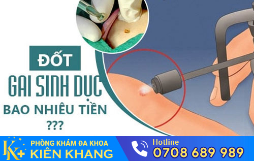 đốt gai sinh dục bao nhiêu tiền?