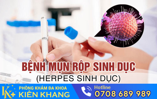 Bệnh mụn rộp sinh dục