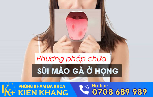 Phương pháp hỗ trợ chữa sùi mào gà ở họng
