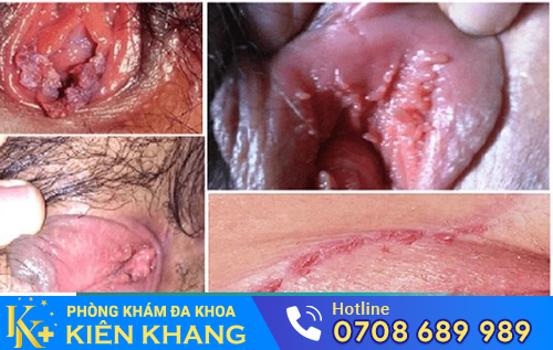 Hình ảnh sùi mào gà ở âm đạo