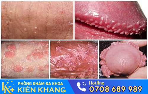 Sùi mào gà ở dương vật