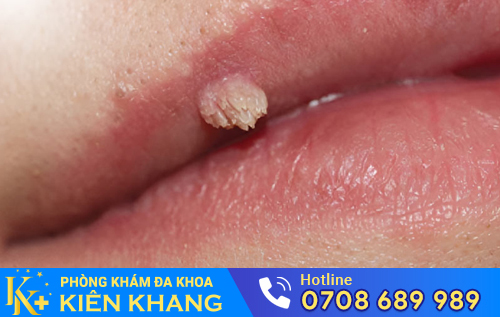 Hình ảnh sùi mào gà ở môi