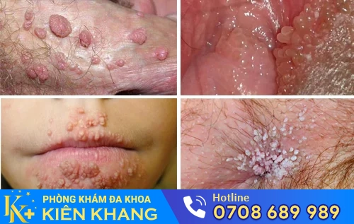 sui mao ga tren cac bo phan co the