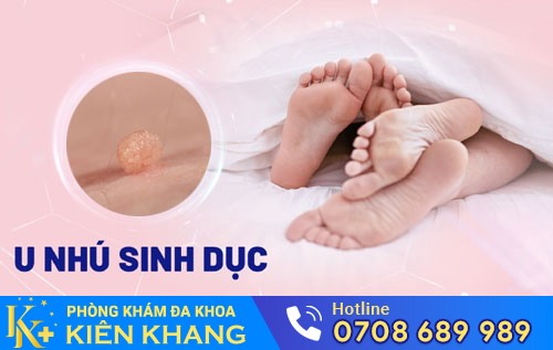 U nhú sinh dục