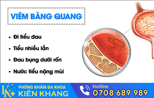 Viêm bàng quang