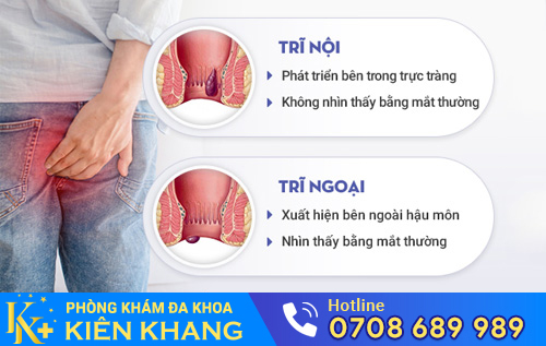 Cách phân biệt trĩ nội, trĩ ngoại