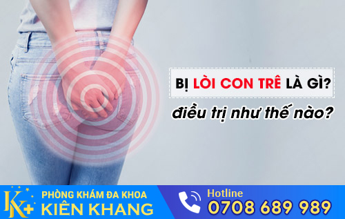 Bị lòi con trê là gì?