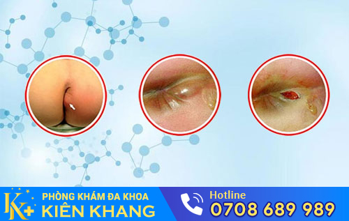 Viêm hậu môn